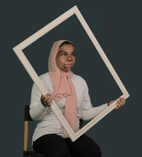 Alvarleg brunasár eru algeng hjá efnaminna fólki í Egyptalandi, ljósmynd: Al Masr